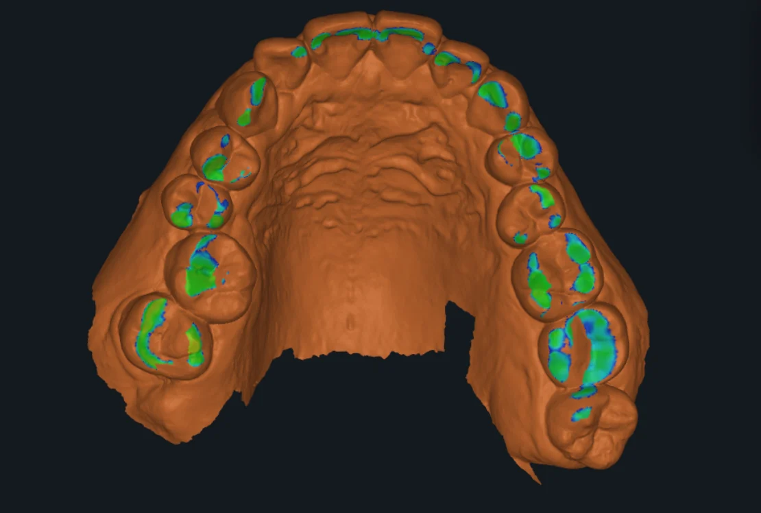 An upper-arch scan in Cympha Studio with a distance map: the contacts to the opposing arch coloured green to blue on the occlusal surfaces